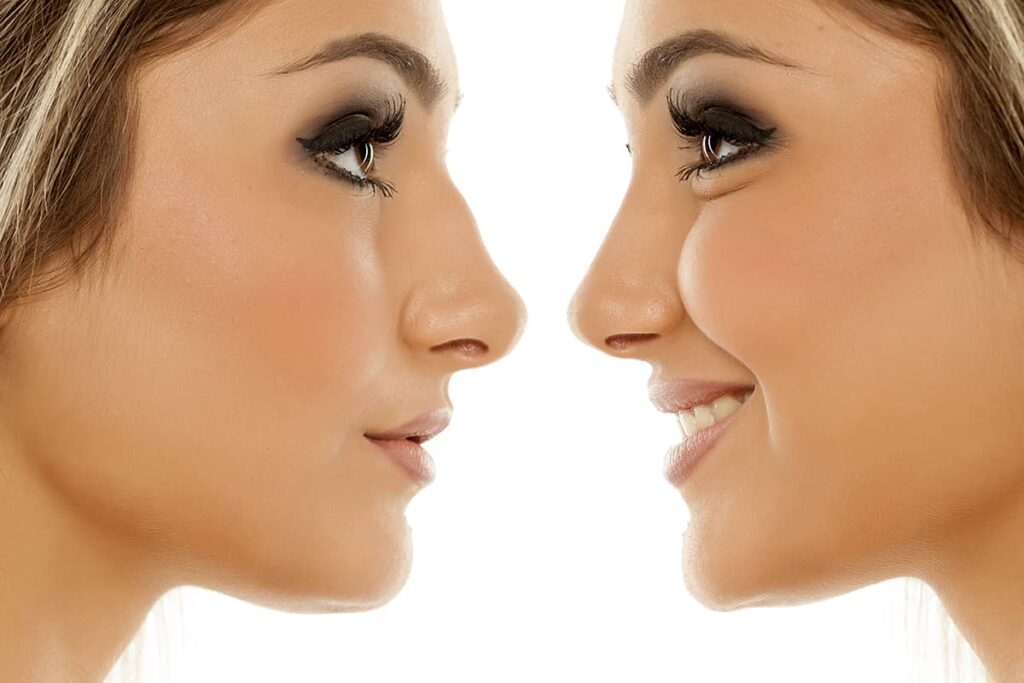 re-Rhinoplasty
